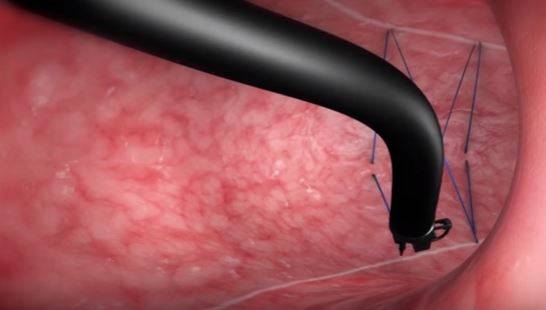 VÍDEO: Gastroplastia endoscópica promove perda de peso sem cirurgia — foto 2