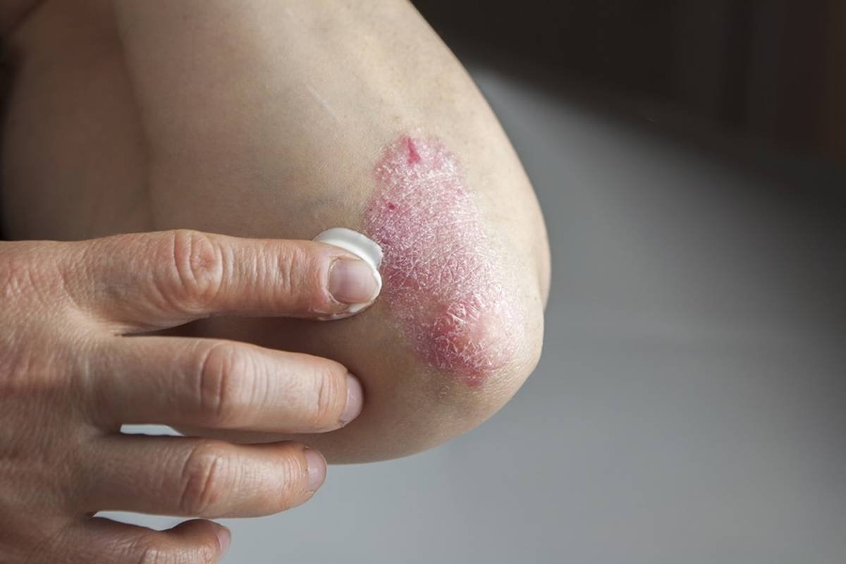 Psoríase: produtos naturais auxiliam no tratamento da doença — foto 2