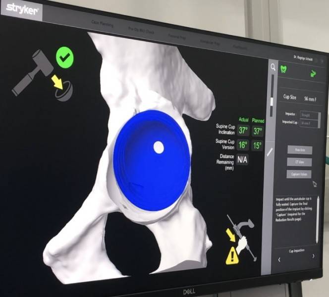 Unimed Criciúma adquire primeiro robô para cirurgia ortopédica de SC — foto 1