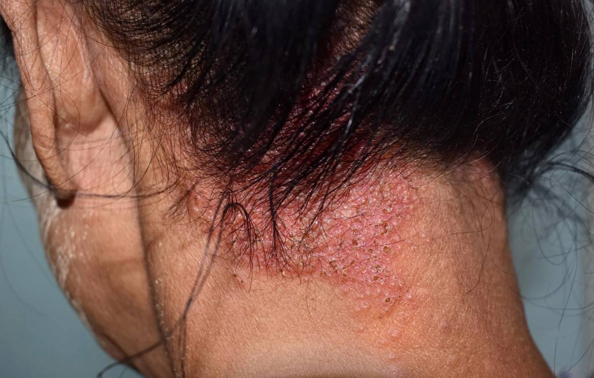 Psoríase atinge quase 3% da população mundial — foto 1
