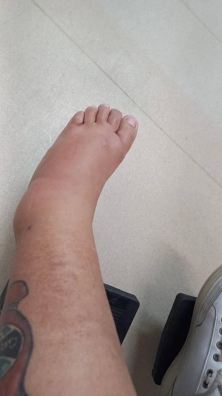 Após perder parte da perna por uma infecção rara, moradora de Criciúma busca apoio para recomeçar — foto 1