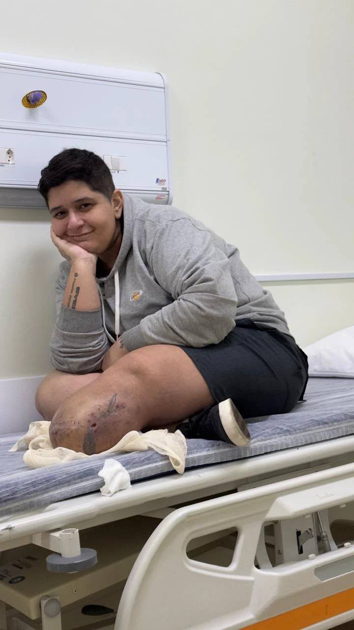 Após perder parte da perna por uma infecção rara, moradora de Criciúma busca apoio para recomeçar — foto 2