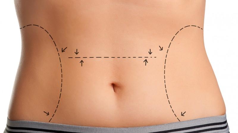 Cirurgia plástica no verão requer cuidados redobrados