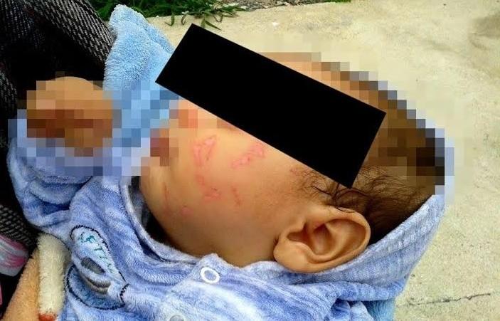 Bebê de três meses fica ferido em creche