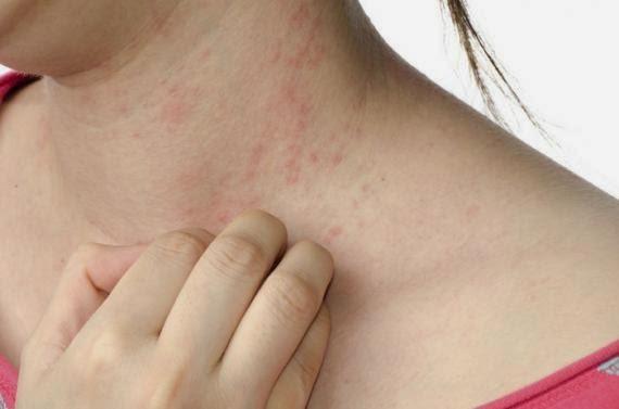 Psoríase: produtos naturais auxiliam no tratamento da doença
