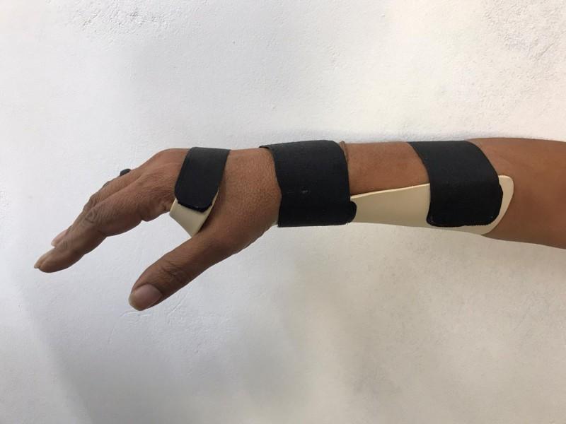 Órteses sob medida trazem maior conforto aos pacientes