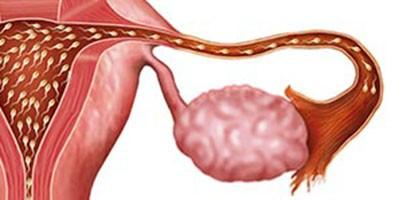 Infecção nas tubas uterinas pode levar à infertilidade
