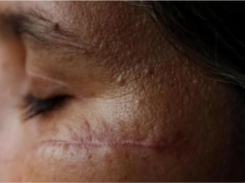 Vítimas de violência doméstica terão cirurgia reparadora