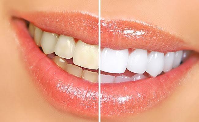 Lente de contato dental: sorriso bonito e alinhado