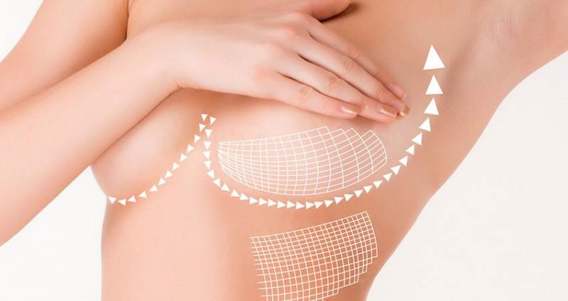Mamoplastia - Você sabia que existem várias formas de realizar a cirurgia?