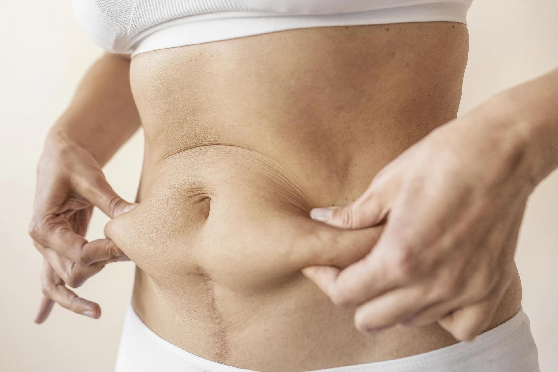 Diástase abdominal ganha visibilidade e amplia debate sobre saúde no pós-parto