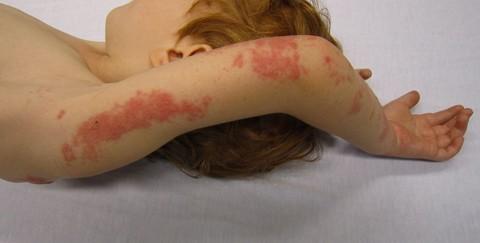 Escola debate os casos de Impetigo nesta manhã