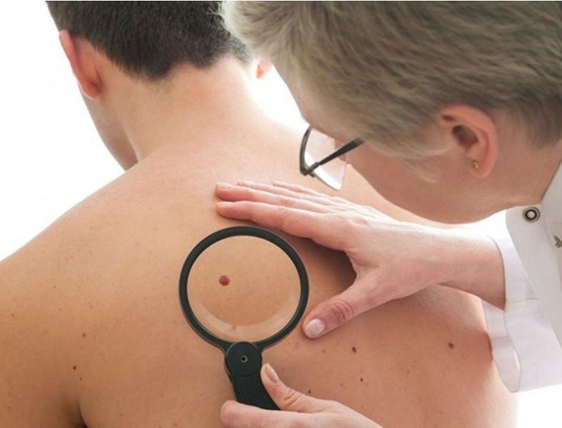 Fundação do Câncer dá dicas de prevenção ao câncer de pele