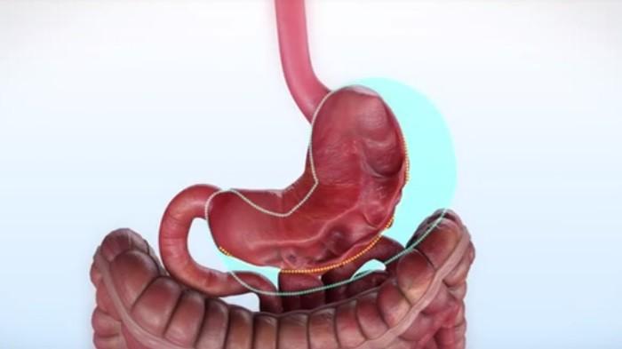 VÍDEO: Gastroplastia endoscópica é nova opção para tratamento da obesidade